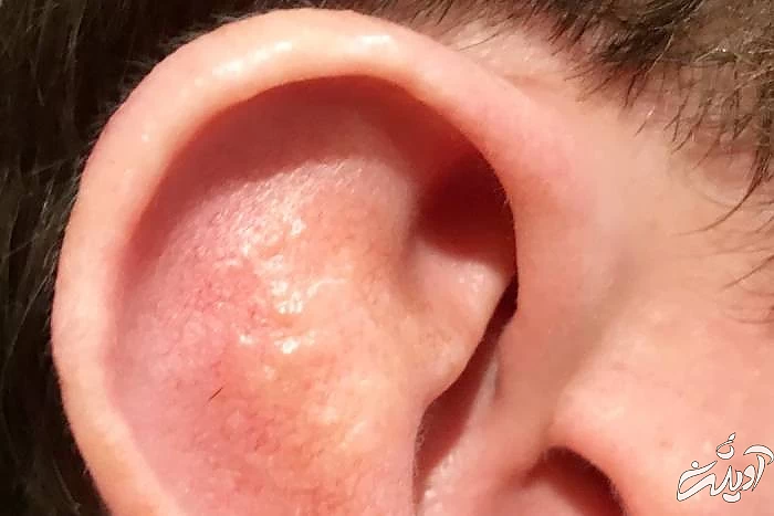 علائم اصلی سندروم رمسی هانت سندروم رمسی هانت